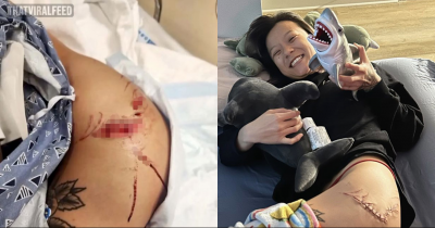 Florida Woman Gets Shark Bite During Friend's Birthday Party