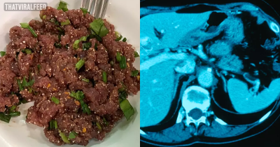Single Bite Of Koi Pla Thai Dish Can Give You Liver Cancer Warns Doctor Narong Khuntikeo