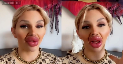 Woman Who Has Undergone Massive Lip Injections Admits It's Difficult To Eat And Drink