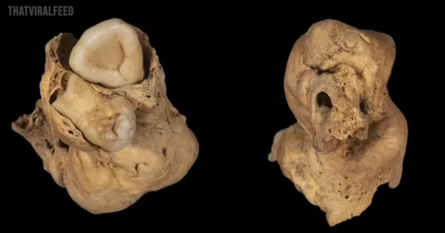 A Tumor With Teeth Was Found In The Pelvis Of An Ancient Egyptian Woman