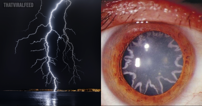Man Left With Strange Burns In His Eyes After Being Zapped With 14,000 Volts Of Electricity
