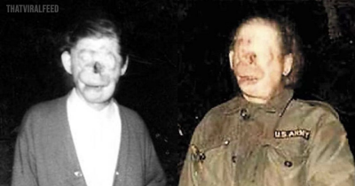Raymond Robinson's Real-Life Tragic Story Of How He Became An Urban Legend &lsquo;Charlie No-Face&rsquo;