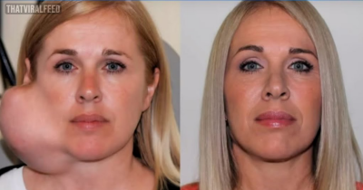 Anguished Mother Has A Massive Tumor Removed From Her Face
