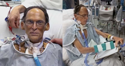 World's First Heartless Human Was Able To Live For A Month Without A Pulse