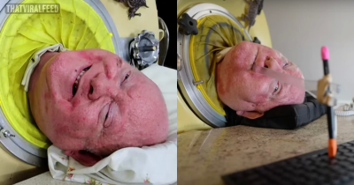 Man Who Lived Inside Seven-Foot Iron Lung For Over 70 Years Has Died Aged 78