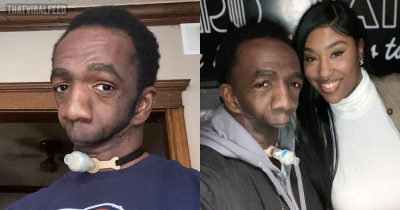 Joseph Williams, Man Born Without A Jaw Who Can't Speak, Eat Or Breathe Properly Has Found Love With Wife After Lifetime Of Pain