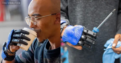 Man Whose Hand Was Crushed In A Meat Grinder Becomes First To Get 3D-Printed Bionic Fingers