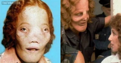 The True Story Of Roy Lee 'Rocky' Dennis Whose 'Rock-Hard' Head Doubled In Size For 16 Years Before Tragic End