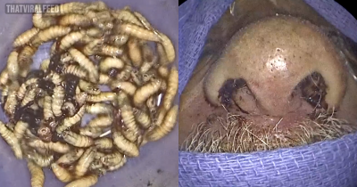 Flordia Man Has 150 Live Bugs Removed From His Nose After Feeling 'Off' For Months