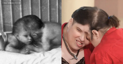 World's Oldest Conjoined Twins George And Lori Have Died Aged 62