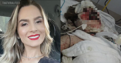 Woman Left &lsquo;Burning From Inside Out&rsquo; In 17-day Coma After Taking Ibuprofen For Stomach Cramps