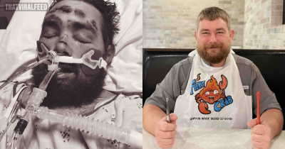 Man Left In Coma And Given 4% Chance Of Survival After Pulling Out Ingrown Hair