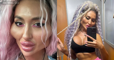 Model With 'World's Biggest Cheeks' Shows What She Looked Like As Natural 26-Year-Old