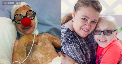Two-Year-Old Given A '0% Chance Of Survival' After Receiving Burns To 98% Of His Body Is Now Inspiring Others