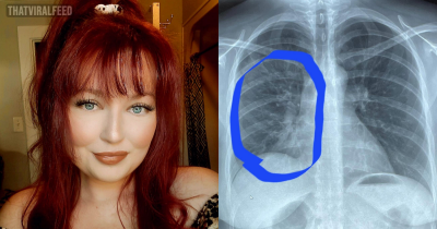 Mother, 30, Left With Lungs Of 80-Year-Old After Vaping 'Fried Her Lungs Like Chicken Wings'
