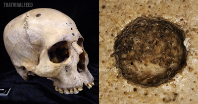 'Extraordinary' 4,000 Years Old Egyptian Skull Shows Medical Attempts To Treat Cancer