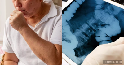 Man&rsquo;s Intestines Fall Out Of His Body After Sneezing And Coughing During Breakfast