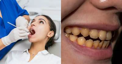 Expert Explains How To Avoid Getting Yellow Teeth After Dentist Shared Common Mistake People Make