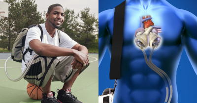 Man Lived Without A Heart For 555 Days Carrying Around An Artificial One In A Backpack
