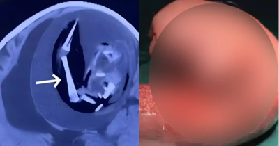 Doctors Are Left Astounded After Finding A Fetus Growing In A One-Year-Old Girl's Skull
