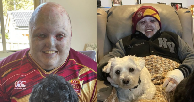 Man Lives With 'Worst Disease You've Never Heard Of' That Makes Skin 'Fragile As Tissue'