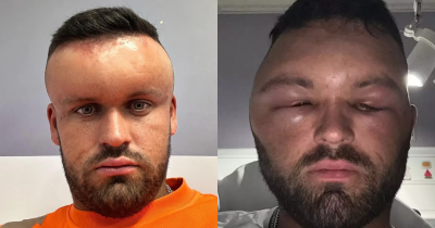 Man Left Looking Like 'Megamind' After Having Huge Reaction So Bad His Girlfriend 'Couldn&rsquo;t Look At Him'