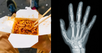 Student Lost All His Limbs After Eating His Roommate&rsquo;s Leftover Food