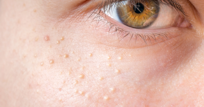 How to Safely Remove Milia