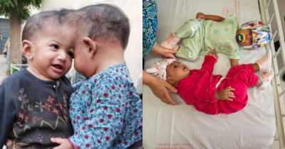 Conjoined Twins Have Been Successfully Separated Following Groundbreaking 14-Hour Surgery Using Virtual Reality