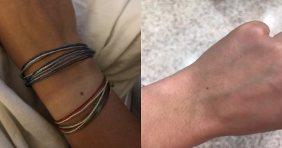 Reason So Many People Seem To Have The Exact Same Freckle