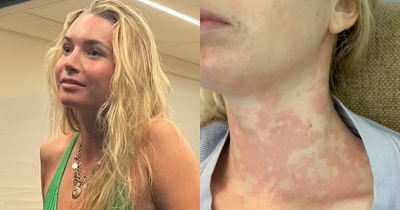 Woman Suffers From Rare Condition That Makes Kissing On The Lips A Potentially Life-Threatening Risk