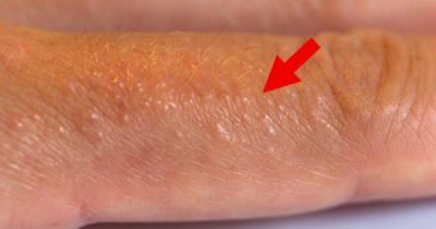 Dyshidrotic Eczema: Causes, Symptoms, and How to Treat It