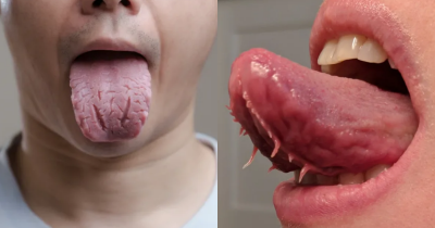Do Some People Really Have Tentacles Under Their Tongue?