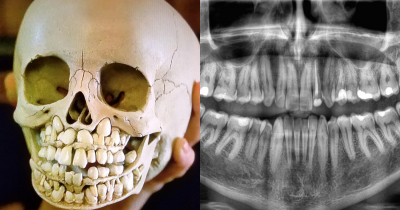 People Shocked And Horrified After Seeing What A Child's Skull Looks Like