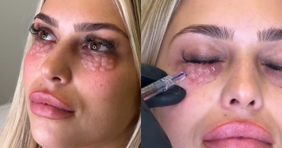 Doctors Warn About Permanent Damage From Beauty Trend That Leaves Skin Looking 'Reptilian'