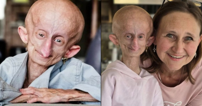 Teenager With Rare Condition, Aging Eight Years Per Year, Passes Away At 19