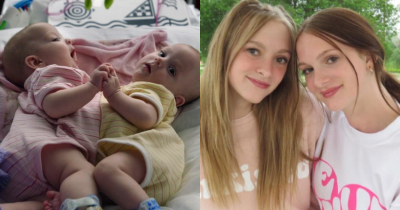 Conjoined Twins Separated As Babies Share Life Update 10 Years Later