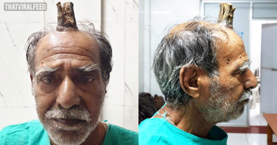 Man's Shock And Horror As Four-inch 'Devil Horn' Grows Out Of His Head