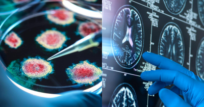 Common Virus Linked To Alzheimer's In Some Individuals