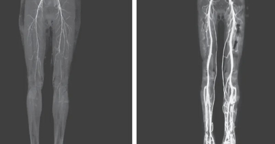 Woman Suffers Burning Leg Pain And Discovers She Has An Ancient Disease Once Known As 'Holy Fire'