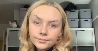 Woman Has To Tape Or Glue Eyes Open Just To See Due To Bizarre Condition