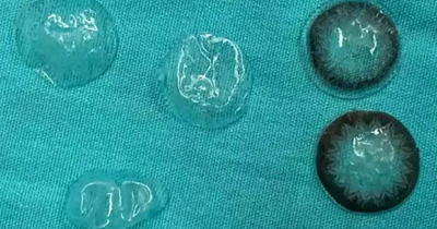 Doctors Warn After Finding Five Contact Lenses Stuck In Woman&rsquo;s Eye