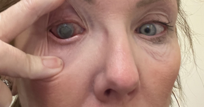 Woman Nearly Loses Sight In One Eye After A Simple Contact Lens Mistake