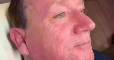 Truck Driver Who Never Used Sunscreen Reveals Dramatic Difference On One Side Of His Face