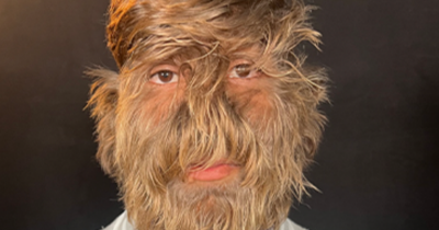 Teen With 'One In A Billion' Werewolf Syndrome Sets Guinness World Record For Hairiest Face