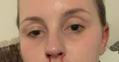 Mum Who Snorted $1.3k-A-Week Of Cocaine Shares Alarming Toll It Took On Her Body