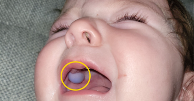 Doctors Were Shocked By What Looked Like A Tumor In Baby's Mouth &mdash; But The Truth Was Totally Unexpected
