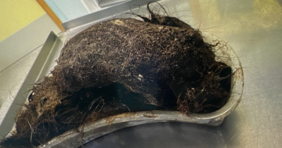 Mom Stunned After Doctors Find Massive Melon-Sized Hairball Causing Daughter's 'Gluten Intolerance' Symptoms