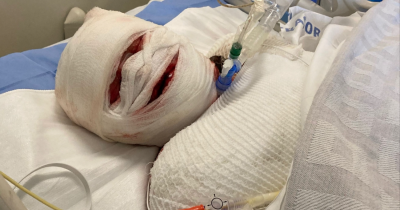 Mom's Skin Peeled Off After Severe Ibuprofen Reaction Left Her In A Coma