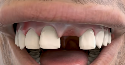 Simulation Reveals The Real Physical Reason Behind Nightmares Of Your Teeth Falling Out